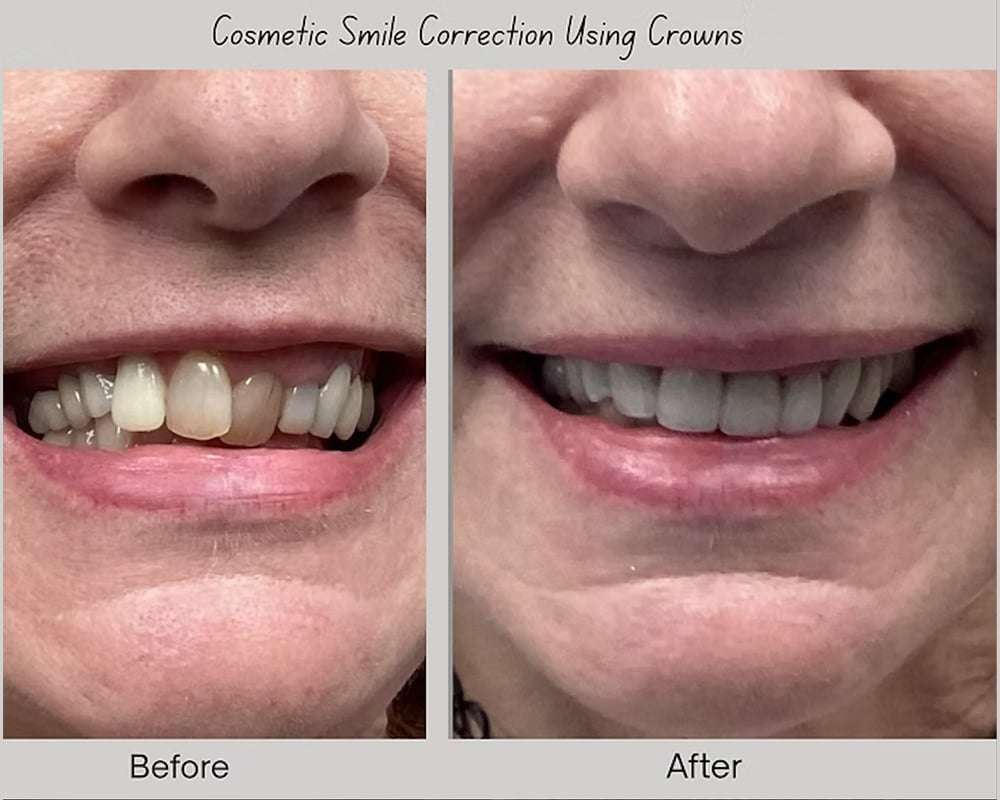 Crown before after