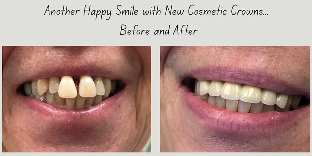 Crown before after