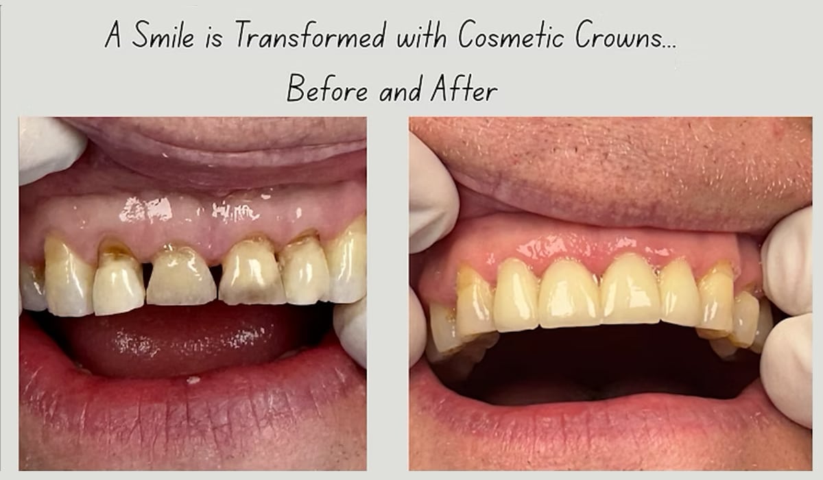 Crown before after