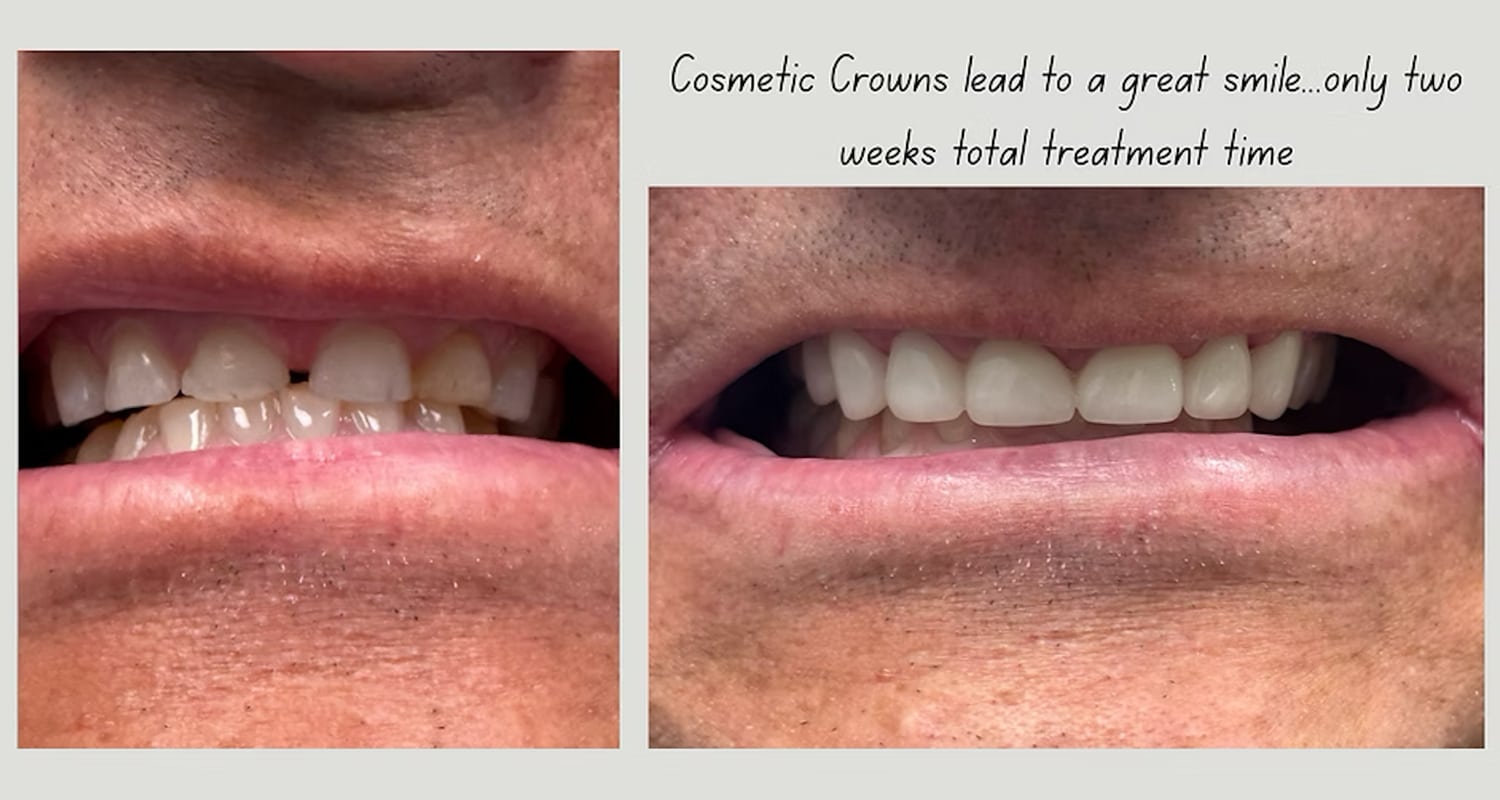 Crown before after
