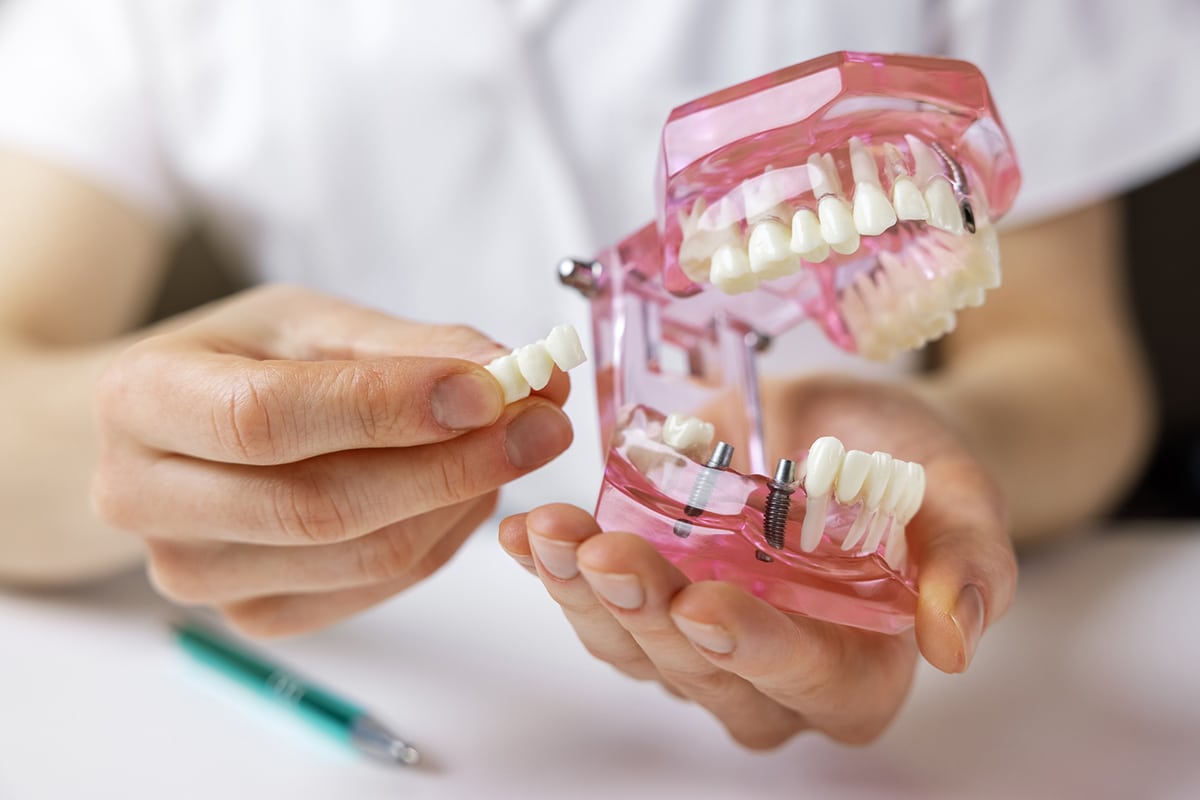 Dental bridges vs implants cost longevity and benefits compared blog